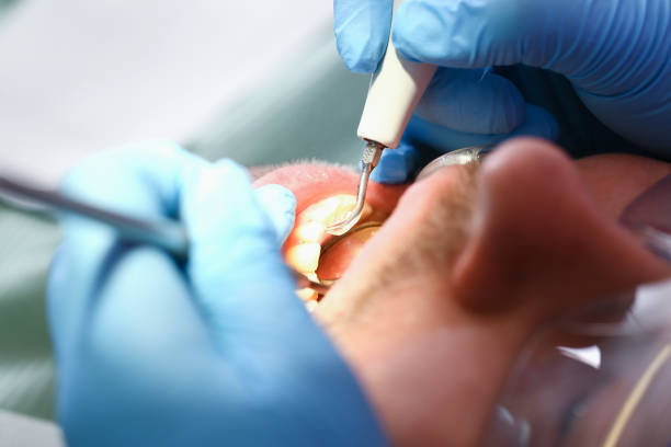 Best Emergency Wisdom Tooth Extraction in Mobridge, SD